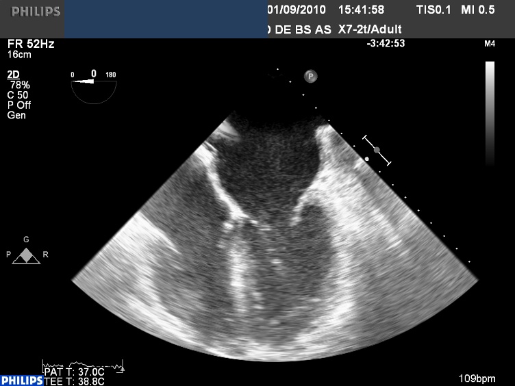 ecocardiograma de insuficiencia cardiaca